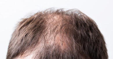 dupa hair loss